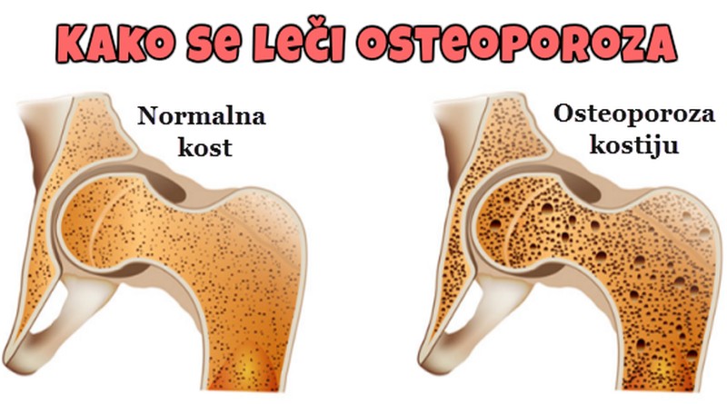 gubitak kostane mase i osteoporoza